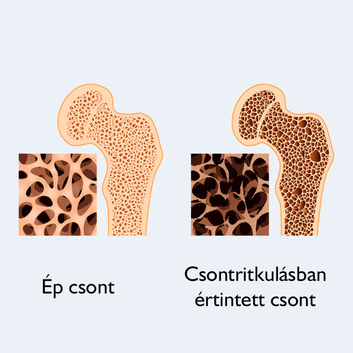 Csontritkulás