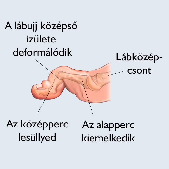 kalapacsujj kialakulása