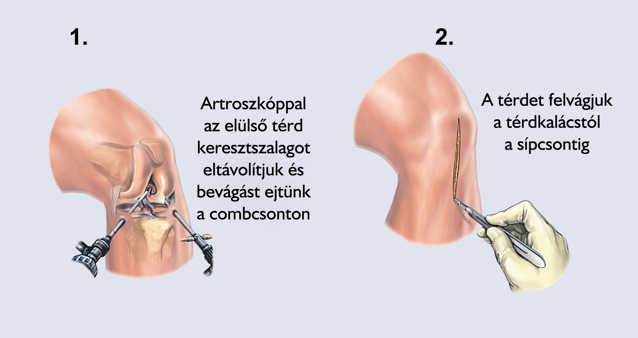 Artroszkópos ACL-rekonstrukció