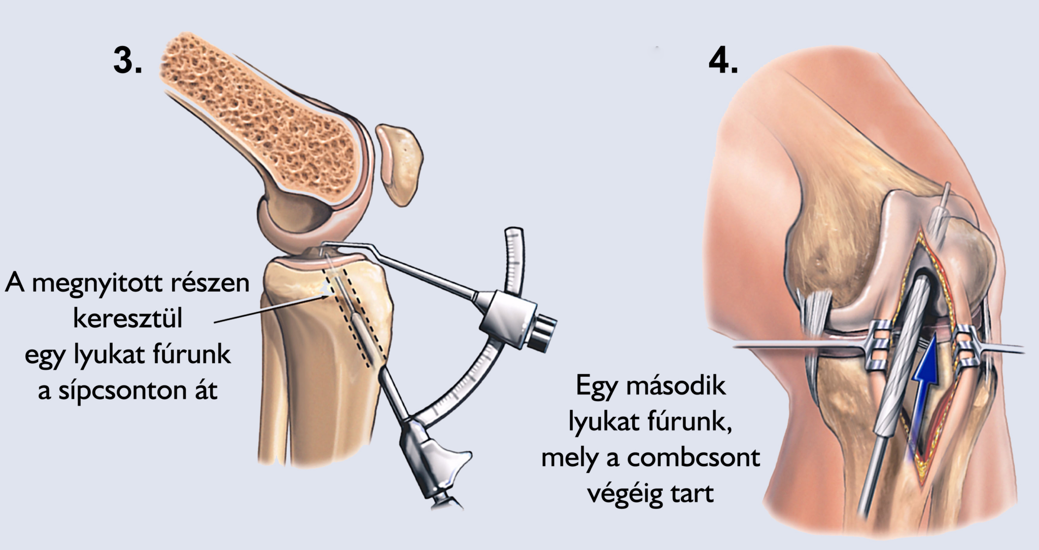 Artroszkópos ACL-rekonstrukció