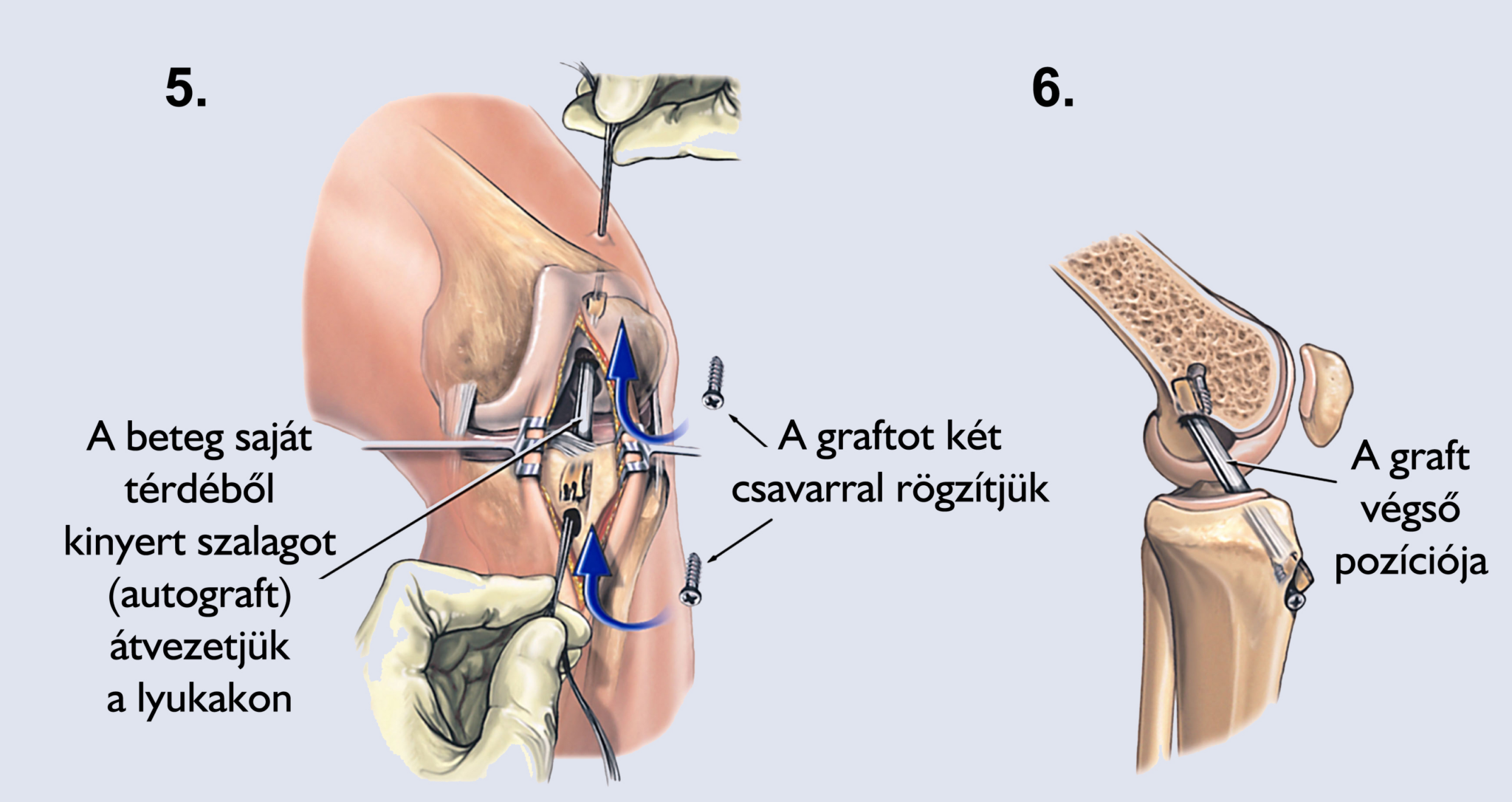 Artroszkópos ACL-rekonstrukció