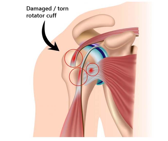 Damaged torn rotator cuff