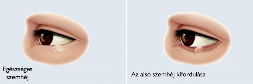 Az alsó szemhéj kifordulása (ektropium)