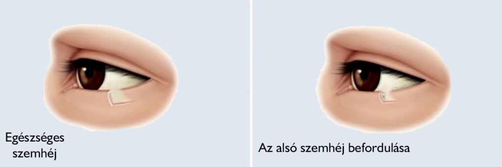 Az alsó szemhéj befordulásának (entropium) kezelése