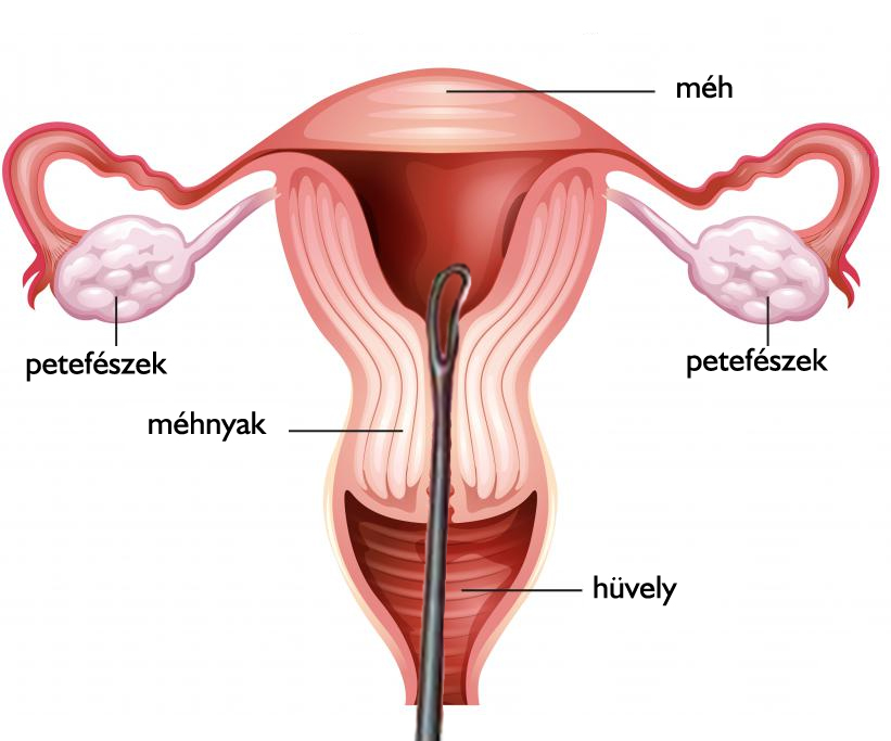 Méhkaparás