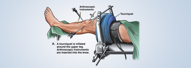 Meniscus