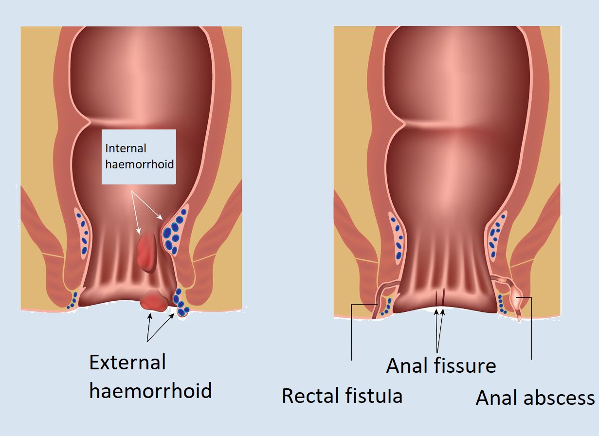 haemorrhoid and fectsl fistula