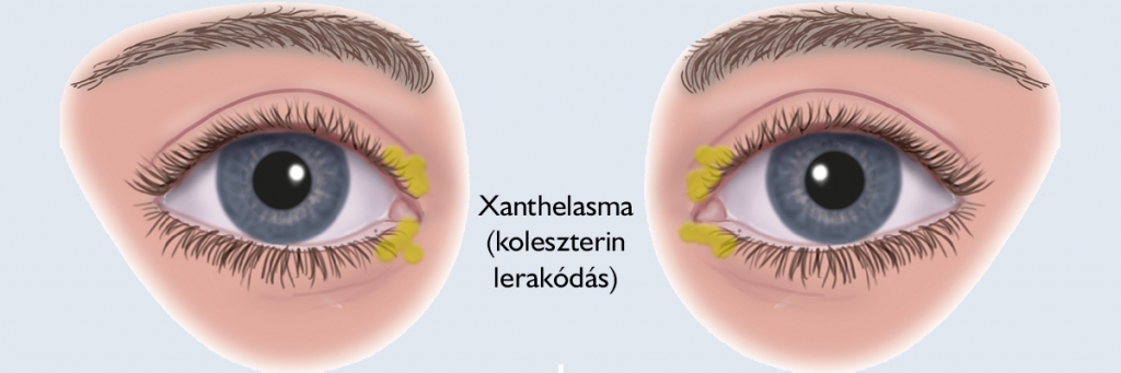 Koleszterin lerakódás