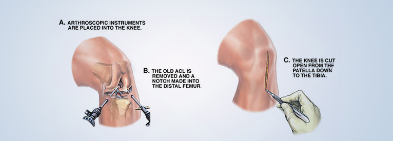 Anterior cruciate ligament (ACL)