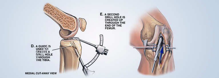 Anterior cruciate ligament (ACL)