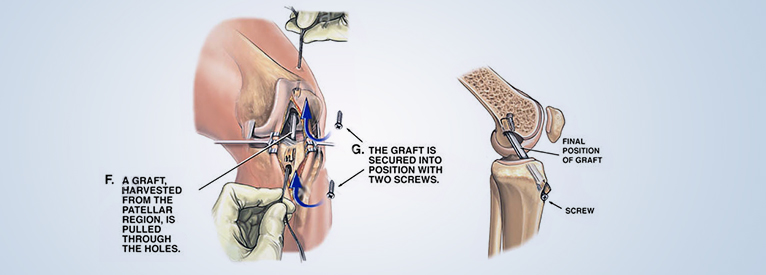 Anterior cruciate ligament (ACL)