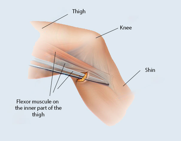 ACL - hamstring