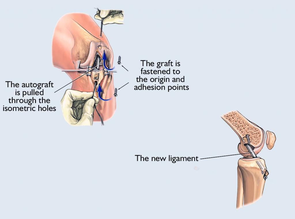 Process of ACL surgery