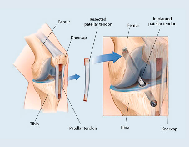 ACL surgery