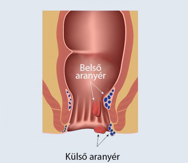 Külső és belső aranyér