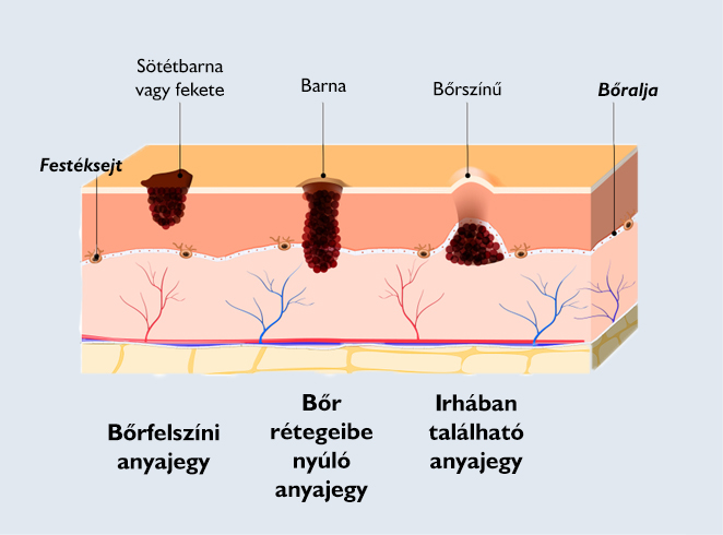 Anyajegy típusai