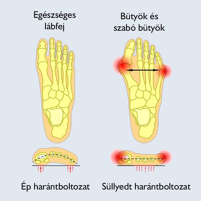 Bütykös lábfej