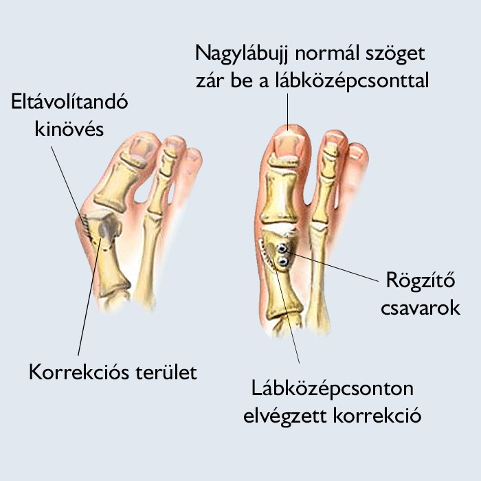 Mi történik a bütyökműtét során?