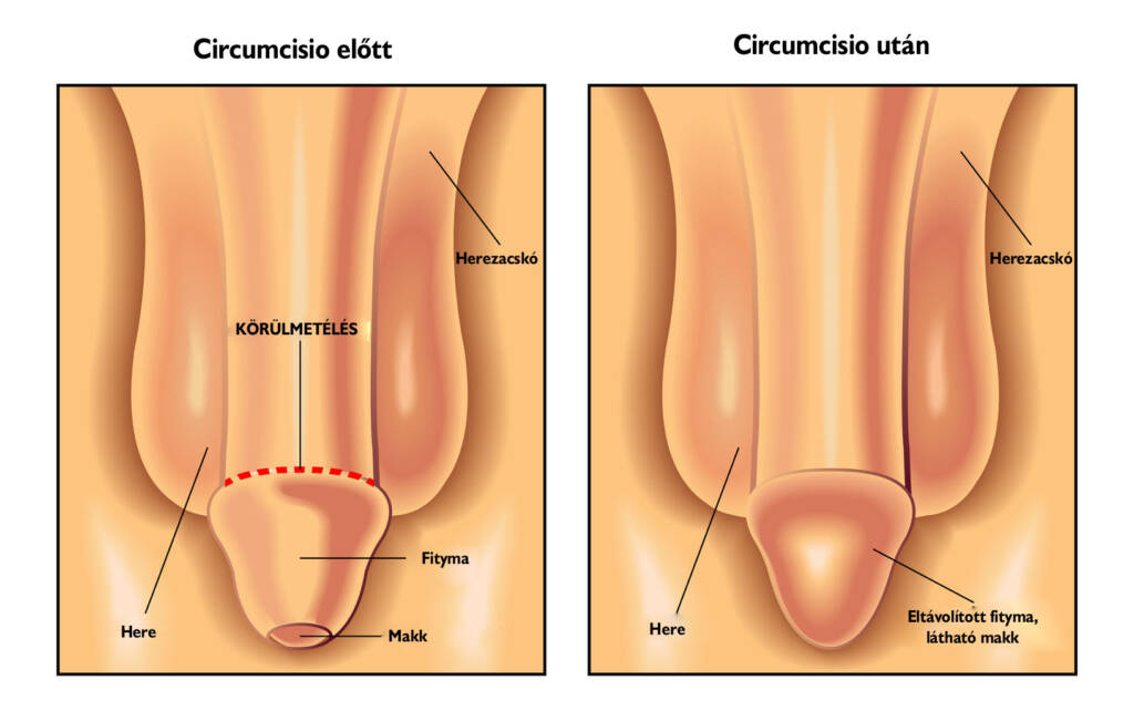 Circumcisio előtt és után — körülmetélés