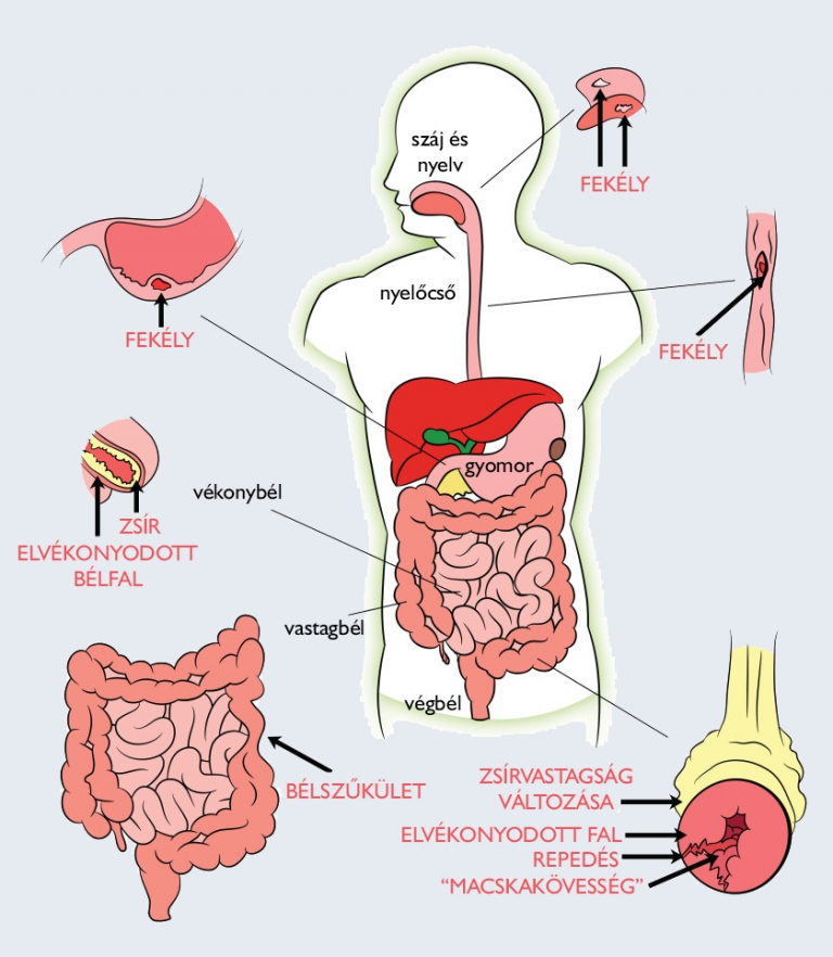 crohn betegség