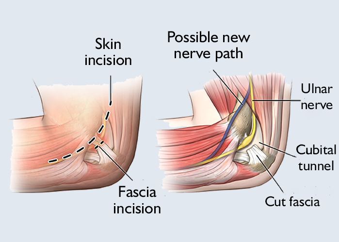 Cubital tunnel release