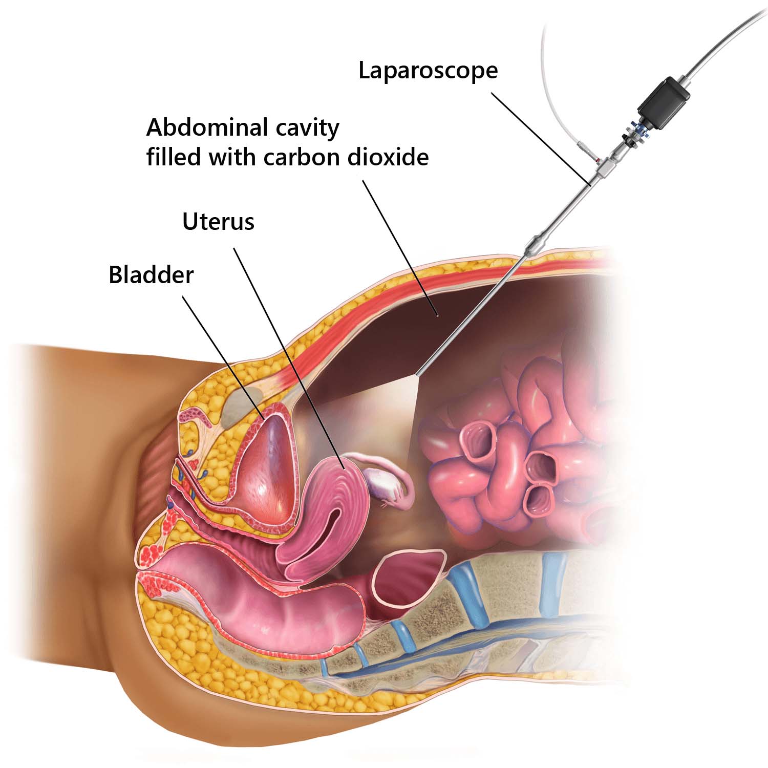 diagnostic-laparoscopy