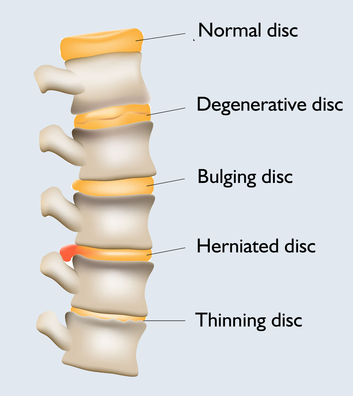 disc degenerations