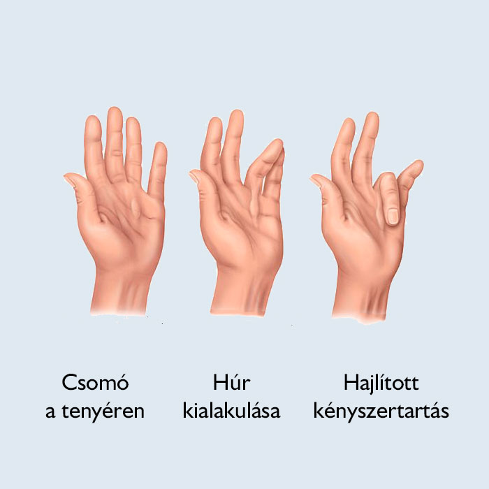 Dupuytren-kontraktúra kialakulása