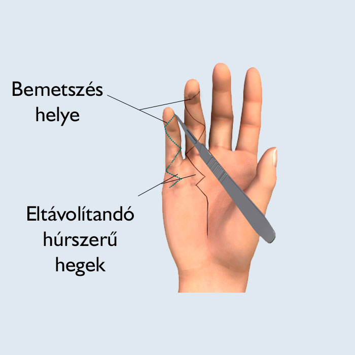 Dupuytren-kontraktúra műtét
