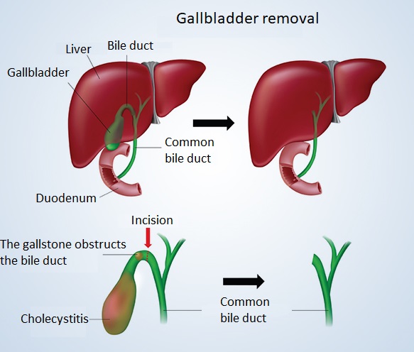 Gallbladder removal