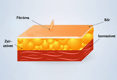 Fibroma
