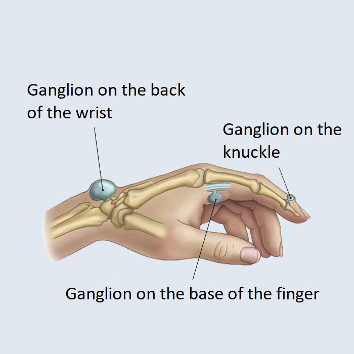 Ganglion