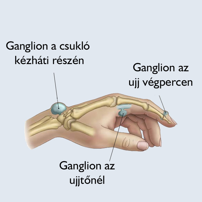Mi a ganglion?