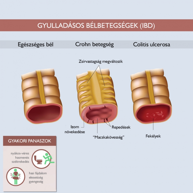 Gyulladásos bélbetegségek