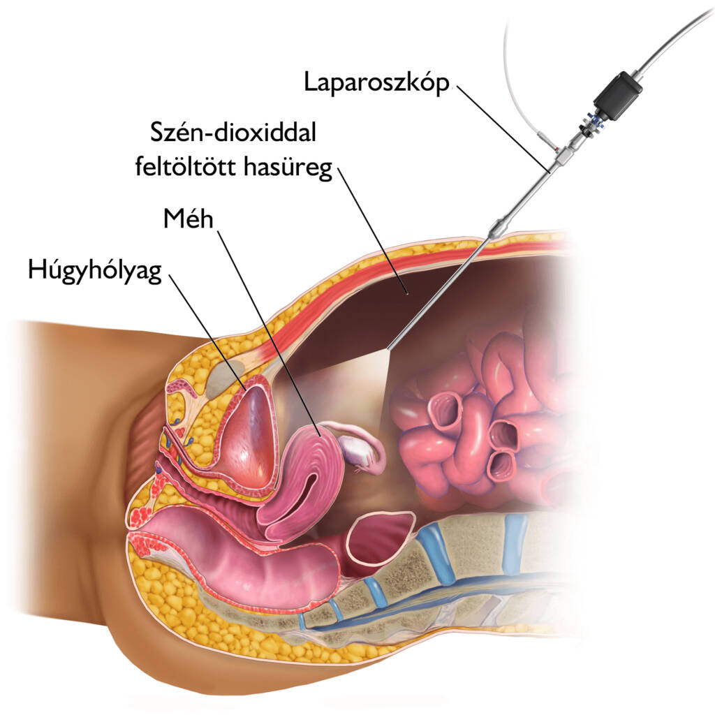 Diagnosztikus laparoszkópia