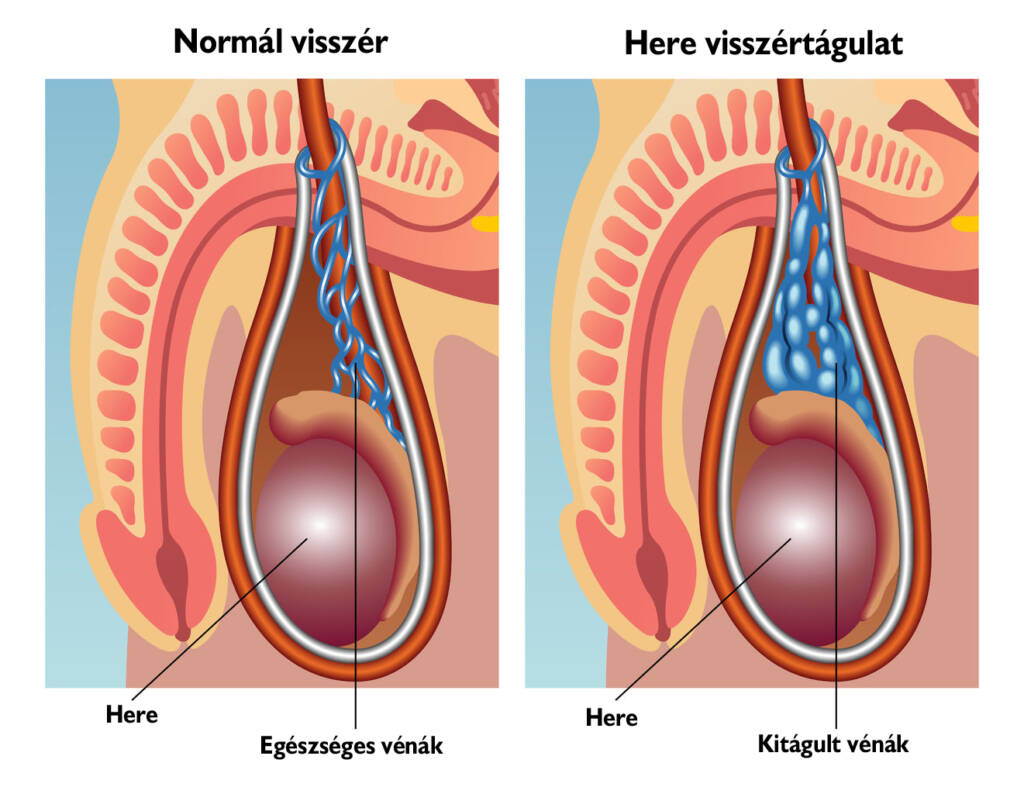 Normál visszér és here visszértágulat
