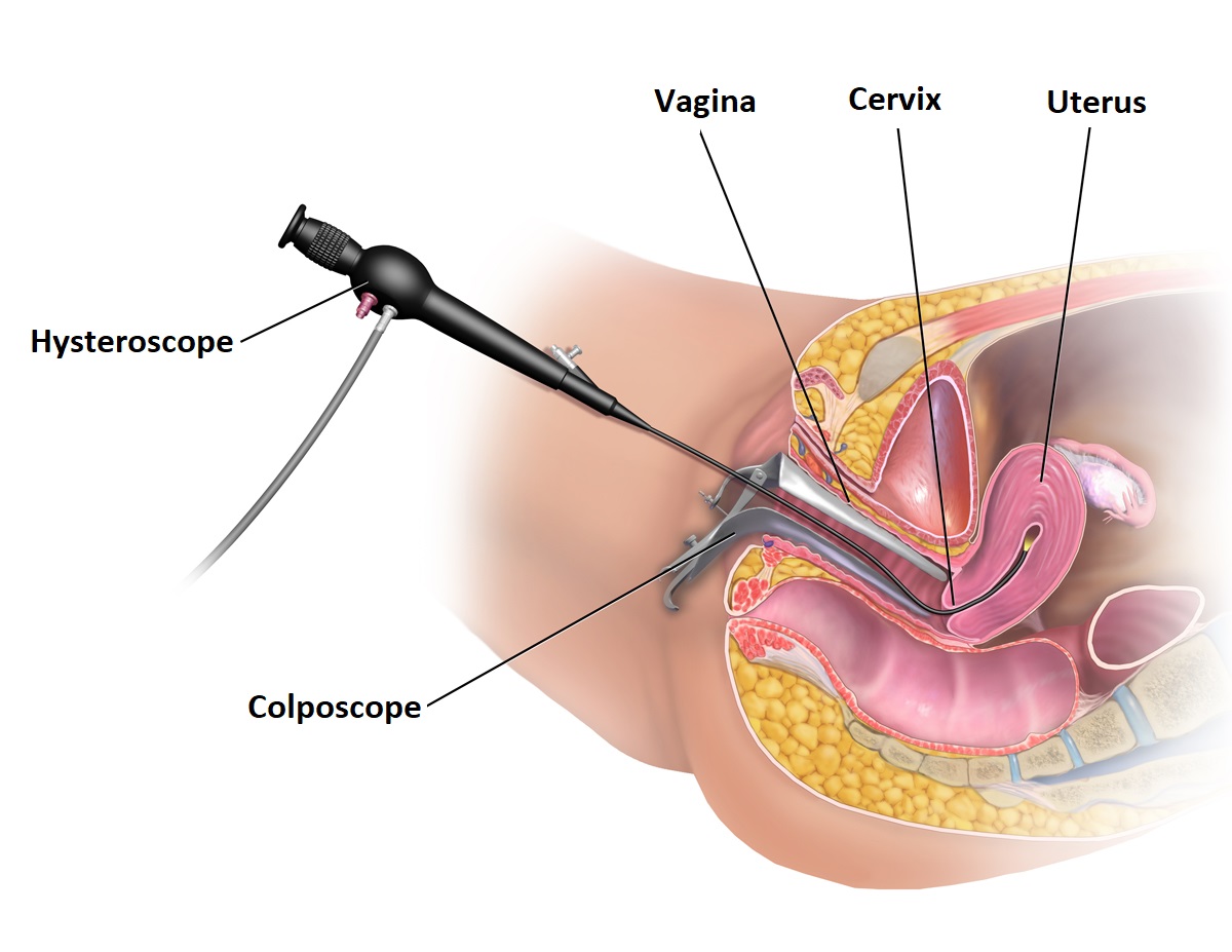 Hysteroscopy