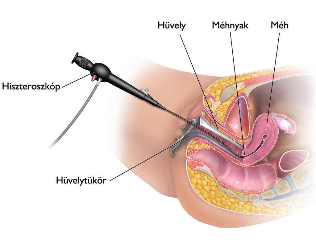 Diagnosztikus hiszteroszkópia