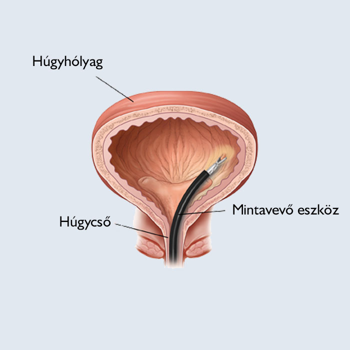 Hólyag biopszia