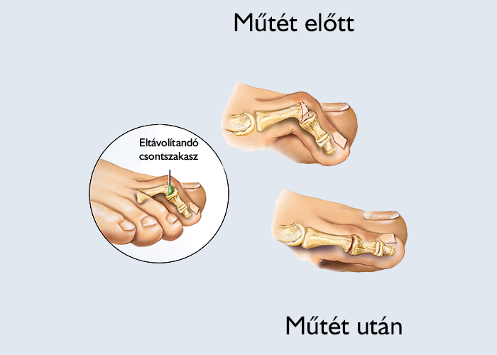 Hogyan zajlik a kalapácsujj műtét?