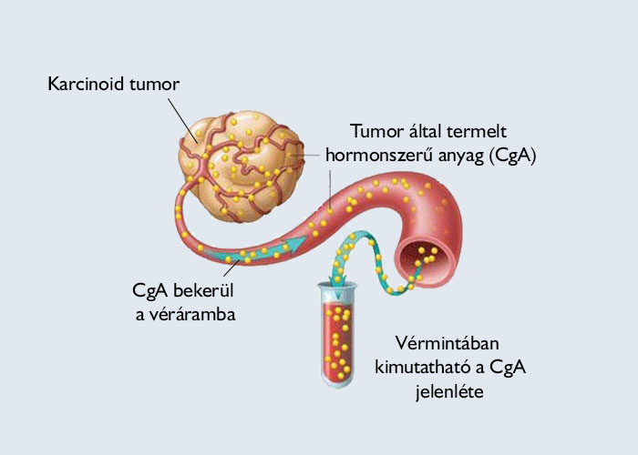 karcinoid tumor