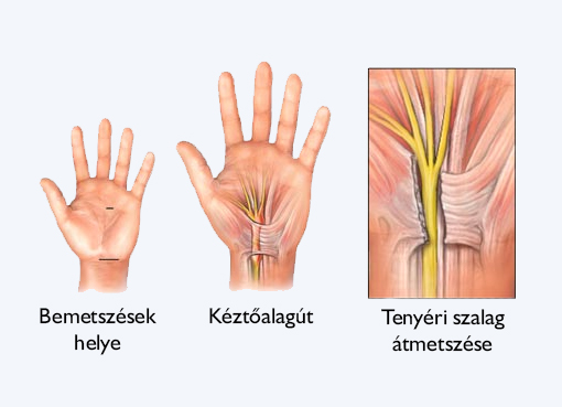 Mi történik a kéztő alagút szindróma műtét során?