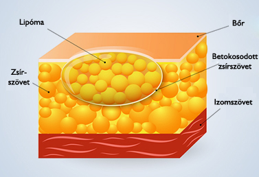 Lipoma