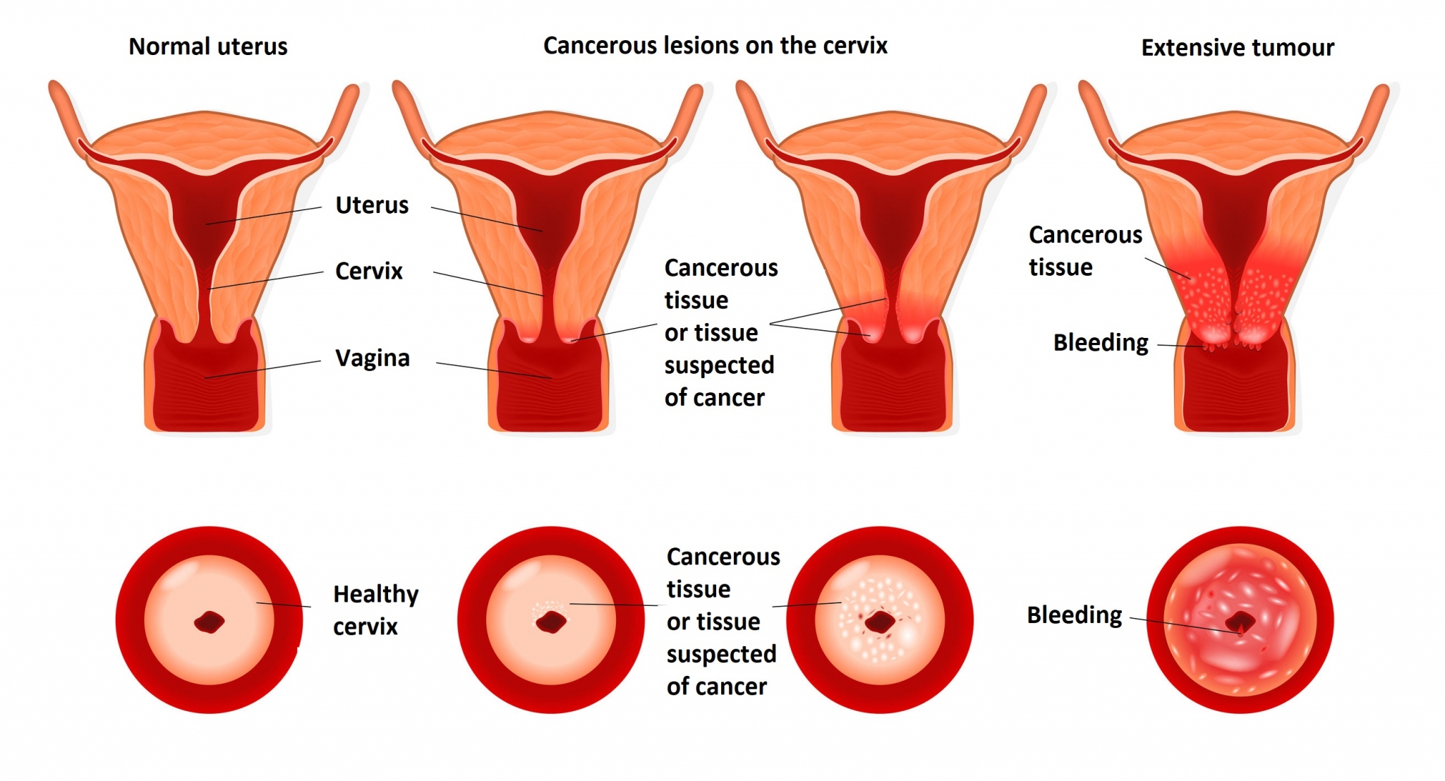 Cervical cancer