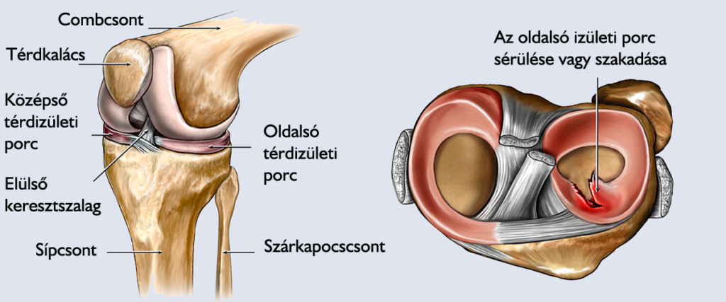 Meniscus szakadás