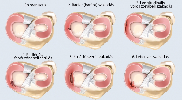Meniscus szakadás