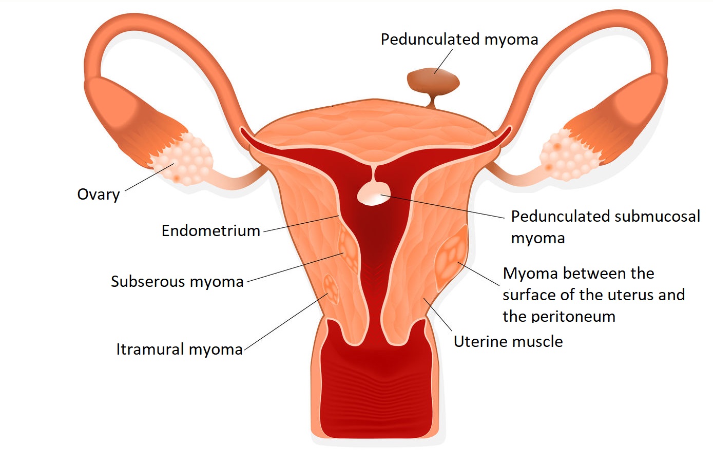 Myoma