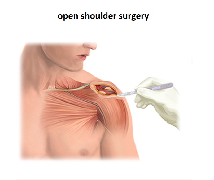 Open shoulder surgery
