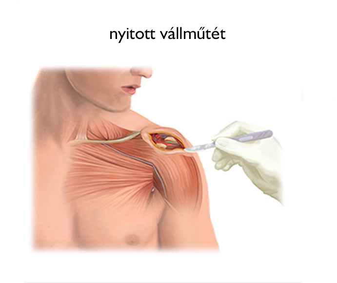 Nyitott vállműtét