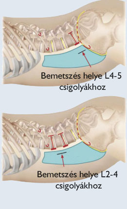 Mi történik az ágyéki gerincstabilizáló OLIF eljárással végzett műtét során?